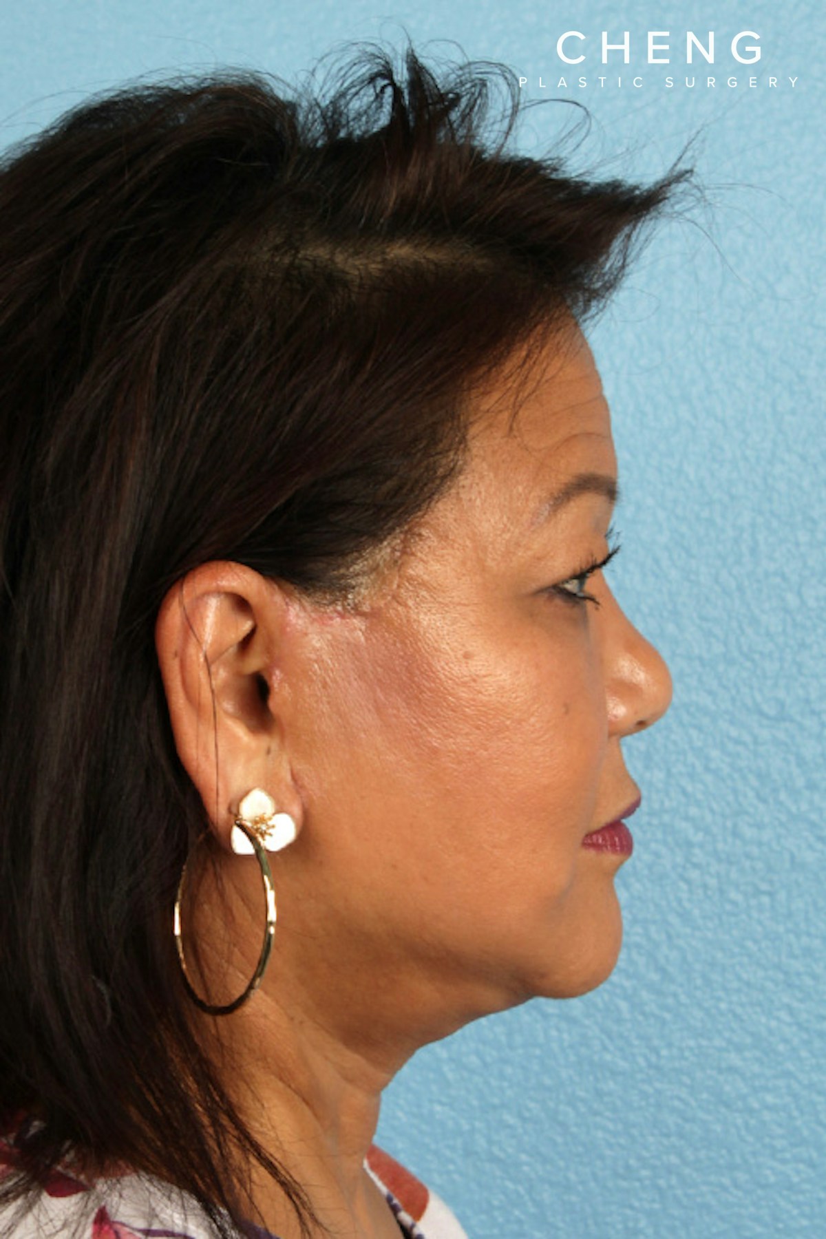 Hidden Patients Before & After Gallery - Patient 273819 - Image 6