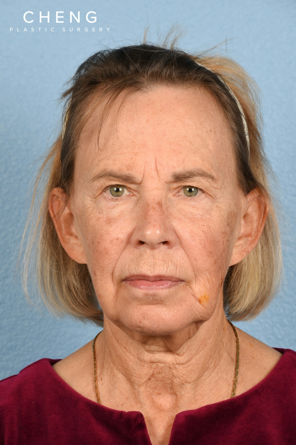 Hidden Patients Before & After Gallery - Patient 616456 - Image 1