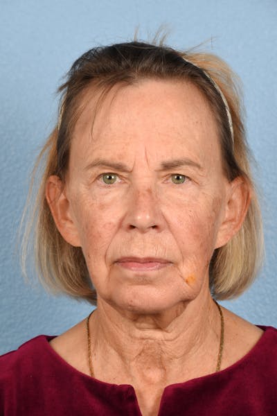 Hidden Patients Before & After Gallery - Patient 616456 - Image 1