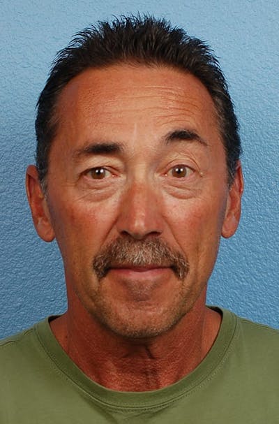 Hidden Patients Before & After Gallery - Patient 357550 - Image 2