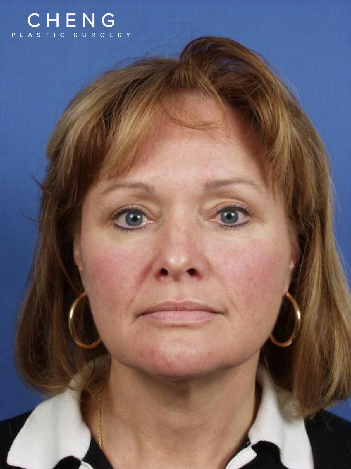 Hidden Patients Before & After Gallery - Patient 176103 - Image 1