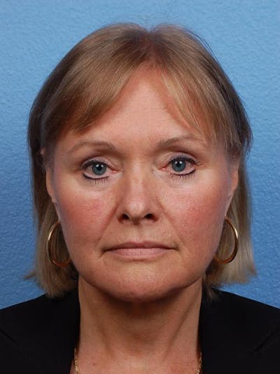 Hidden Patients Before & After Gallery - Patient 176103 - Image 2