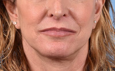 Hidden Patients Before & After Gallery - Patient 265106 - Image 2
