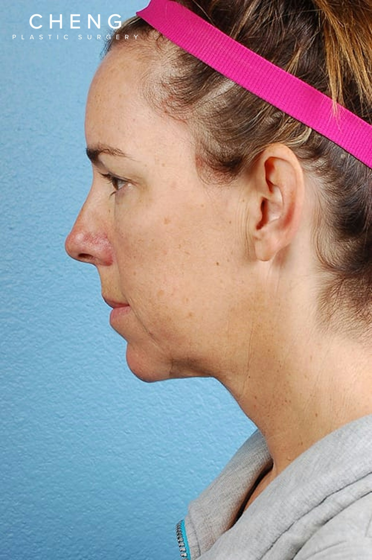 Hidden Patients Before & After Gallery - Patient 470748 - Image 3