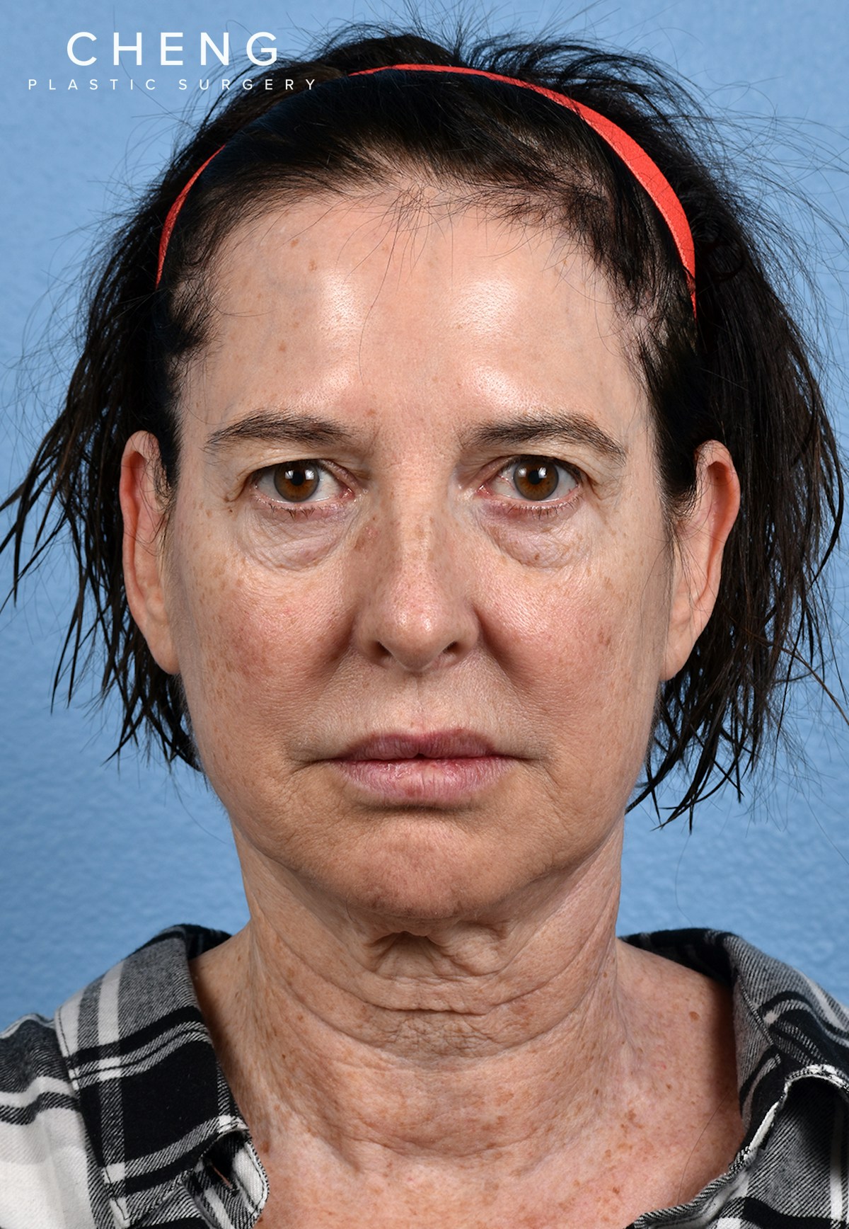 Hidden Patients Before & After Gallery - Patient 310808 - Image 1