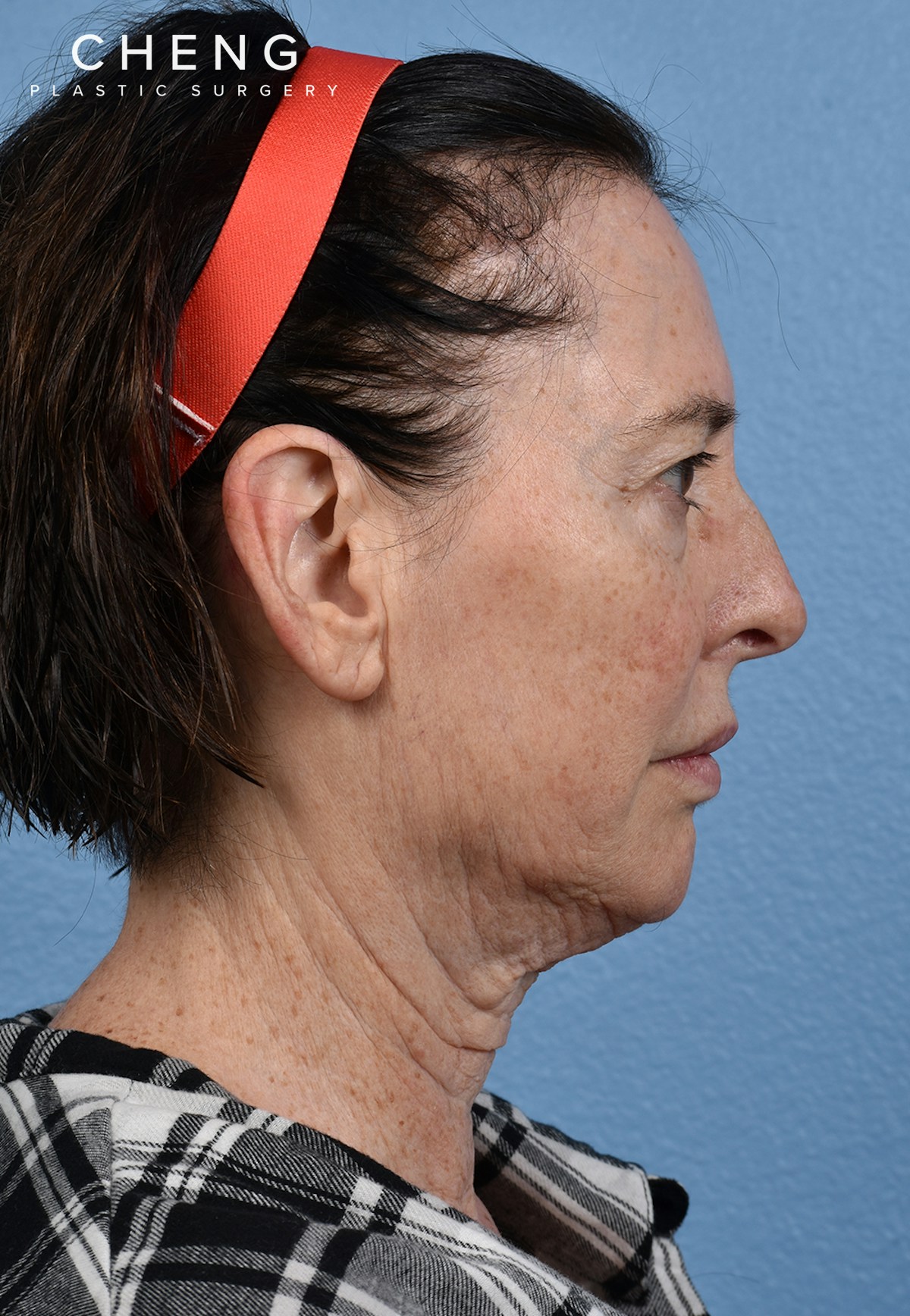 Hidden Patients Before & After Gallery - Patient 310808 - Image 5