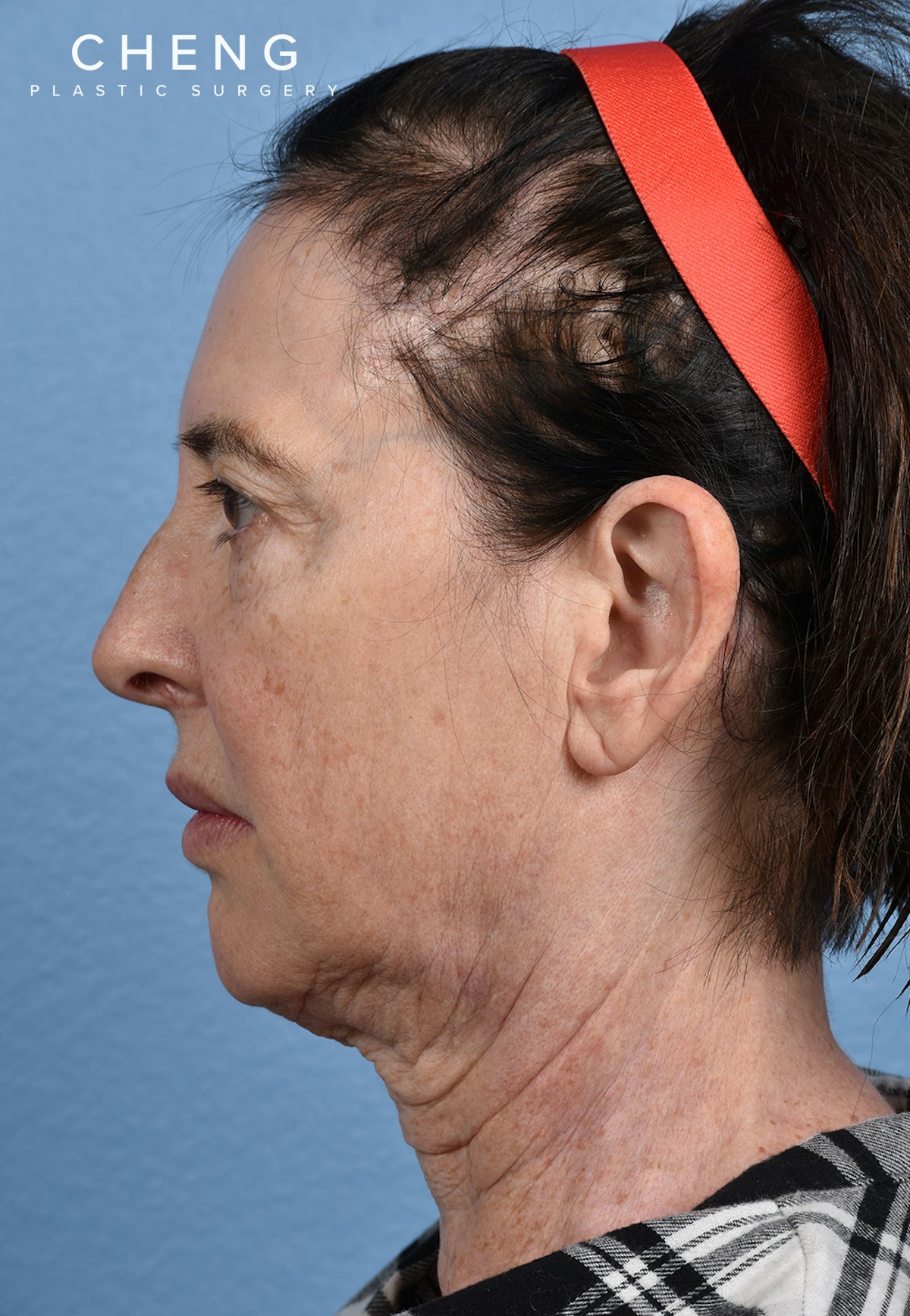 Hidden Patients Before & After Gallery - Patient 310808 - Image 9