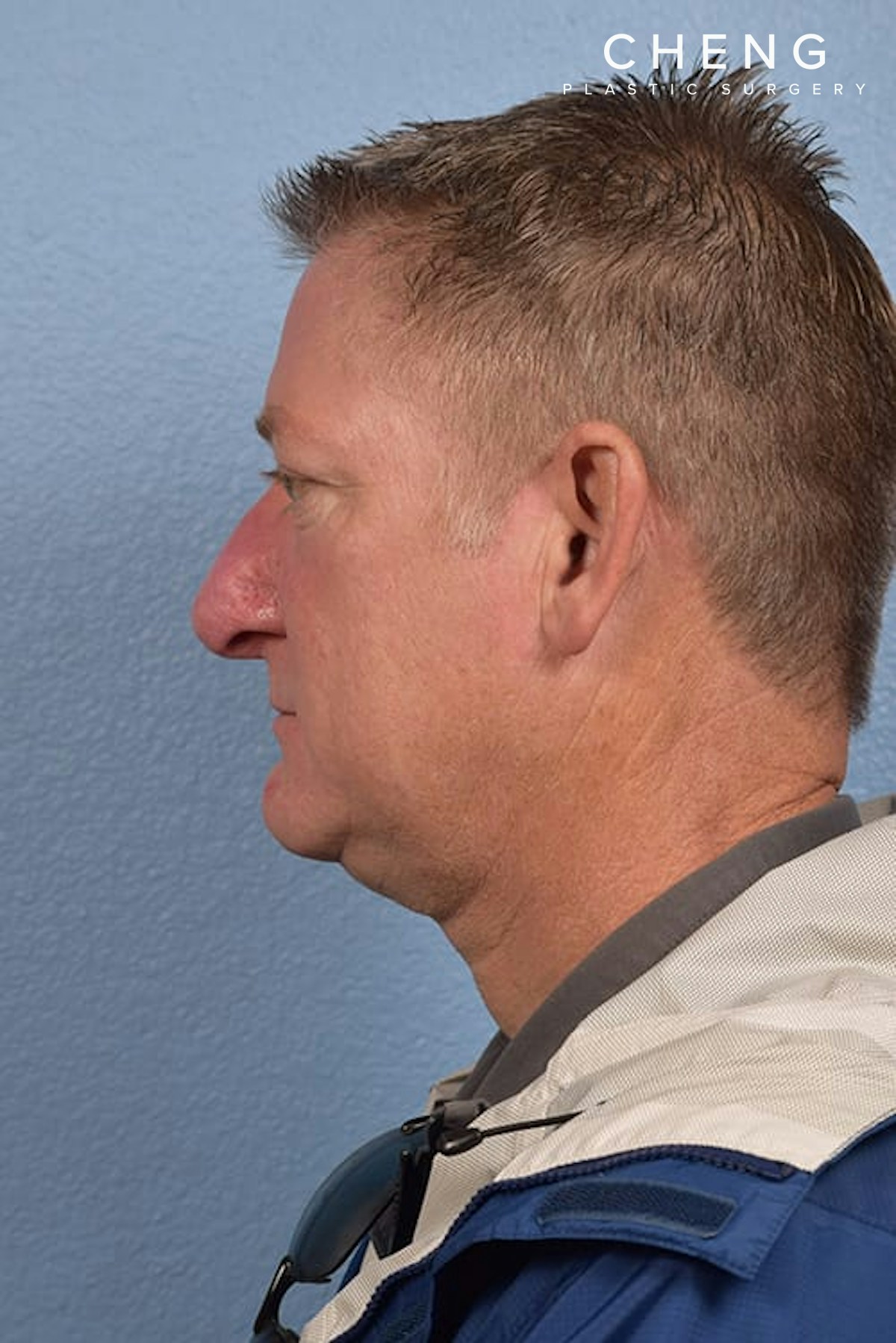 Hidden Patients Before & After Gallery - Patient 532992 - Image 6