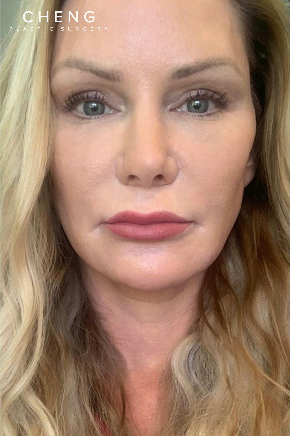 Hidden Patients Before & After Gallery - Patient 402708 - Image 1