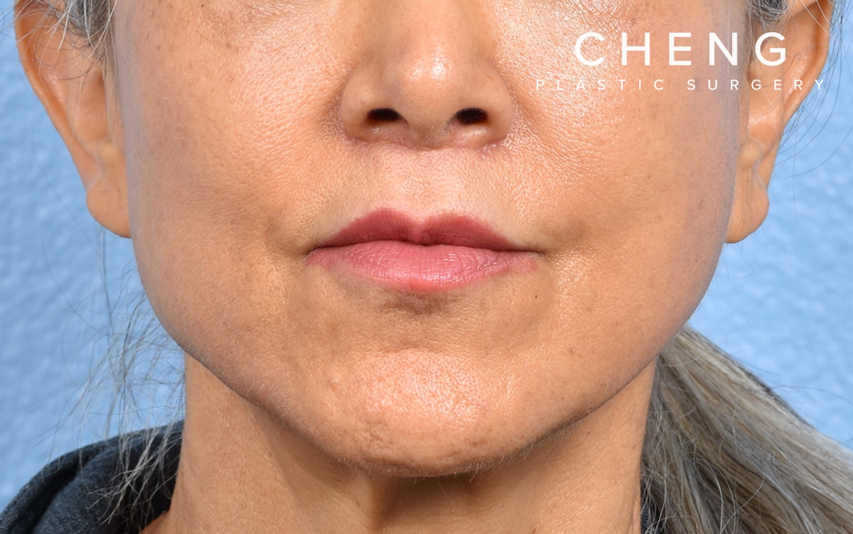 Hidden Patients Before & After Gallery - Patient 372181 - Image 2