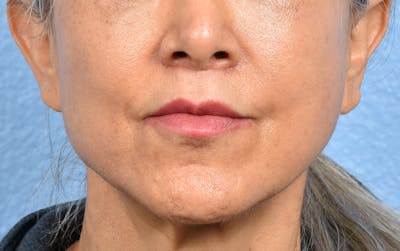 Hidden Patients Before & After Gallery - Patient 372181 - Image 2