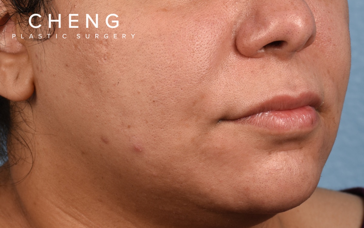 Hidden Patients Before & After Gallery - Patient 279952 - Image 3