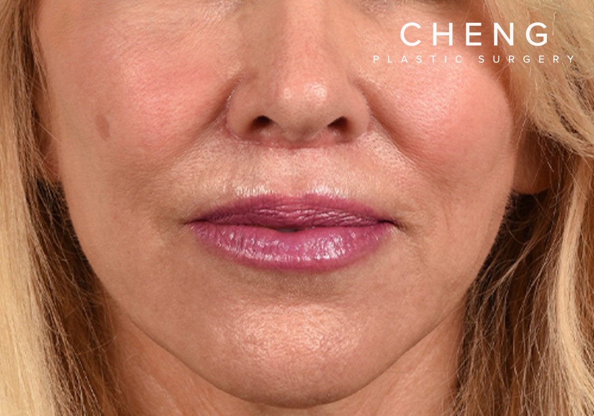 Hidden Patients Before & After Gallery - Patient 320850 - Image 2