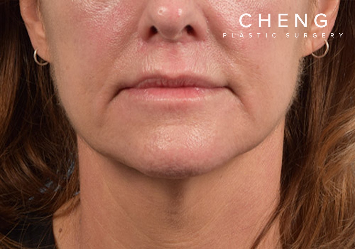 Lip Lift Before & After Gallery - Patient 173901 - Image 2