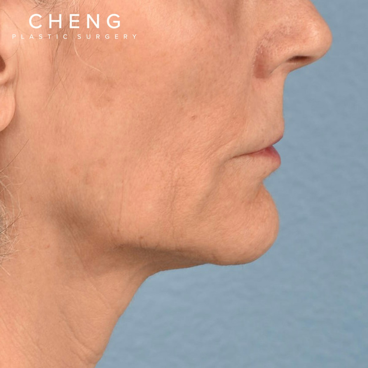 Hidden Patients Before & After Gallery - Patient 165117 - Image 5