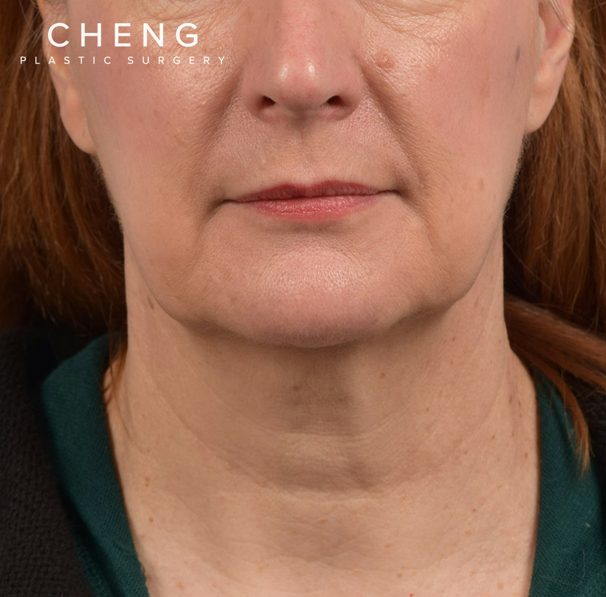 Neck Lift Before & After Gallery - Patient 204140 - Image 1