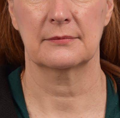 Neck Lift Before & After Gallery - Patient 204140 - Image 1