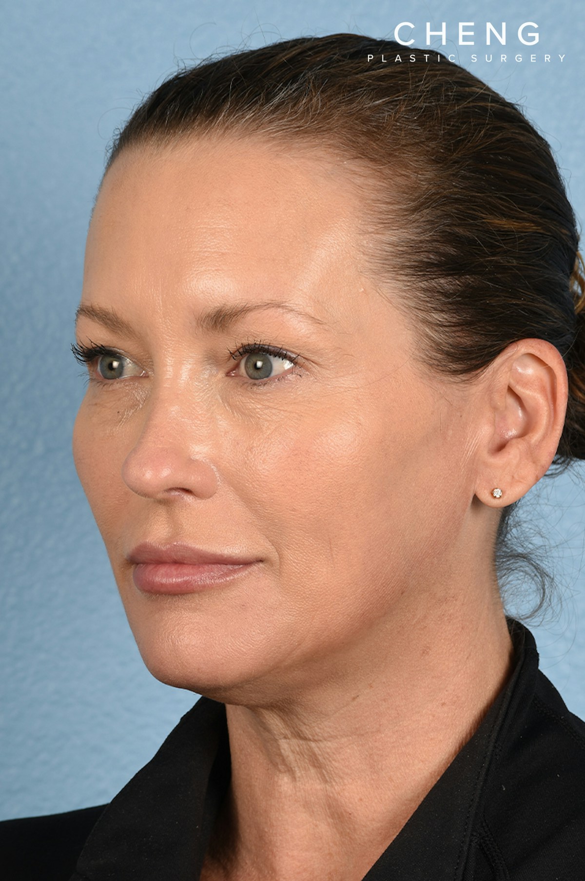 Dermal Fillers Before & After Gallery - Patient 311543 - Image 4