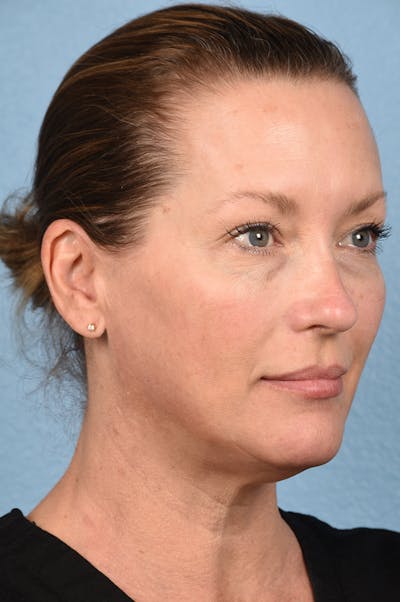 Dermal Fillers Before & After Gallery - Patient 311543 - Image 1