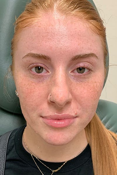 Dermal Fillers Before & After Gallery - Patient 666169 - Image 1