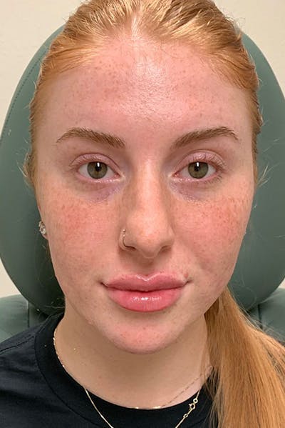 Dermal Fillers Before & After Gallery - Patient 666169 - Image 2