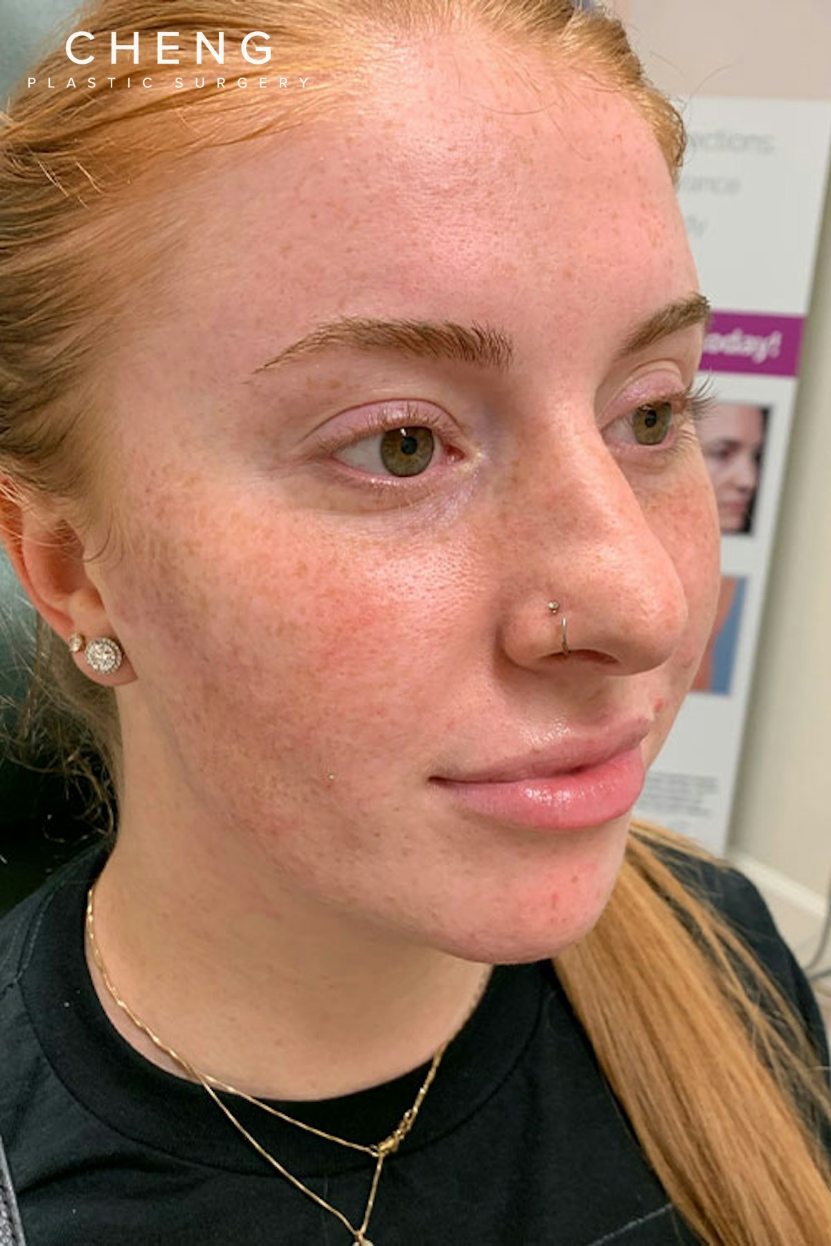Dermal Fillers Before & After Gallery - Patient 666169 - Image 3