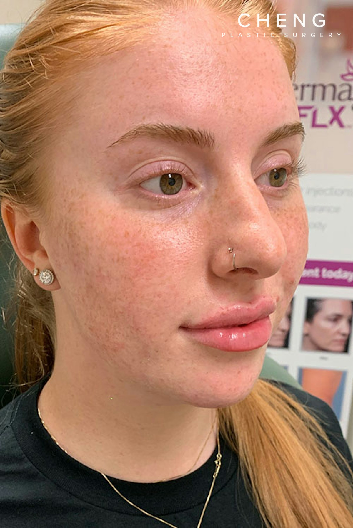Dermal Fillers Before & After Gallery - Patient 666169 - Image 4