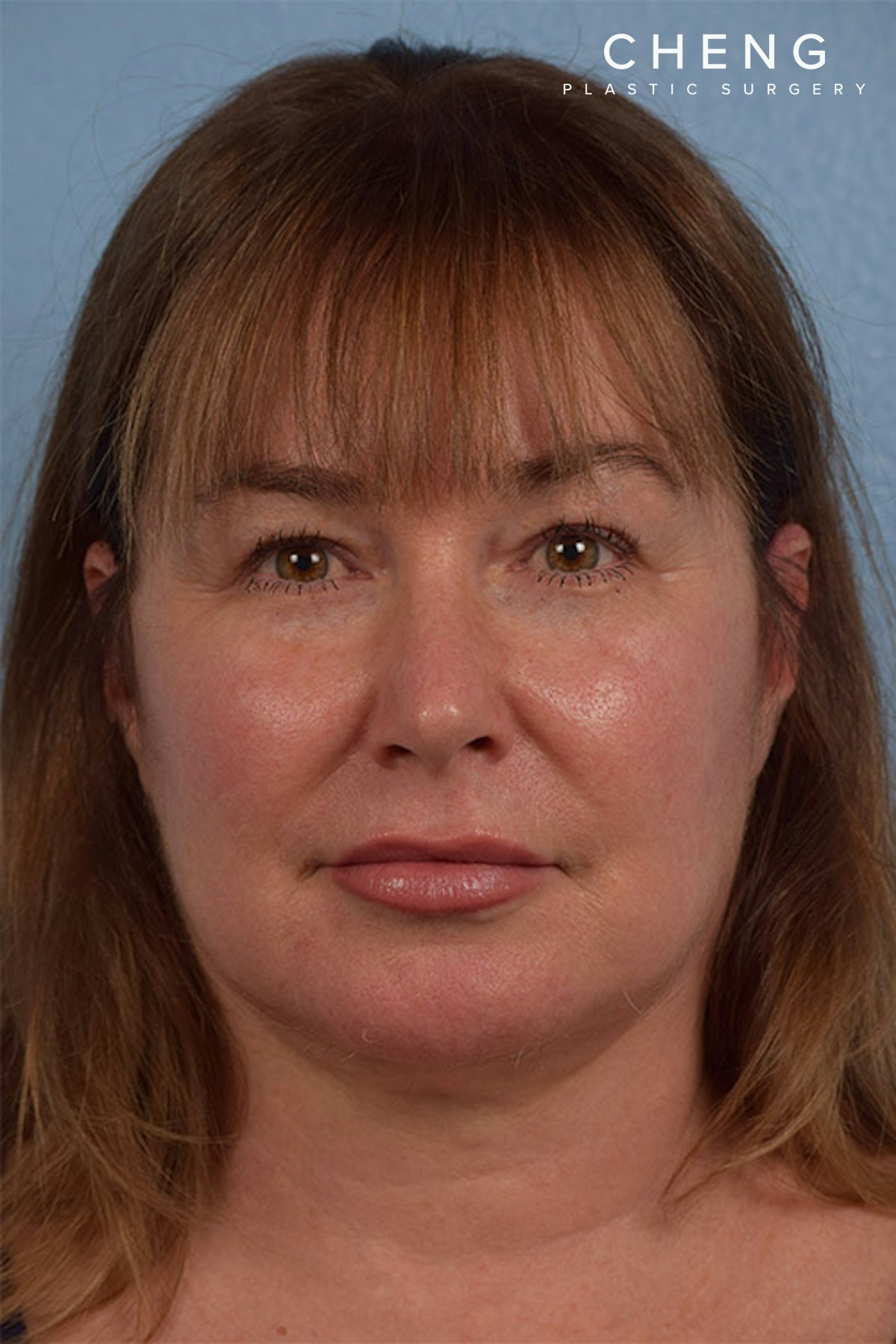 Dermal Fillers Before & After Gallery - Patient 621809 - Image 2