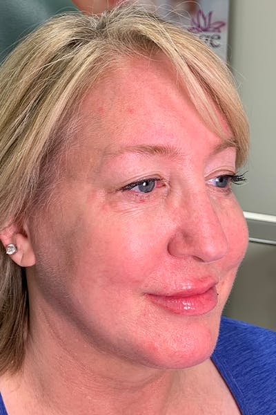 Hidden Patients Before & After Gallery - Patient 176343 - Image 2