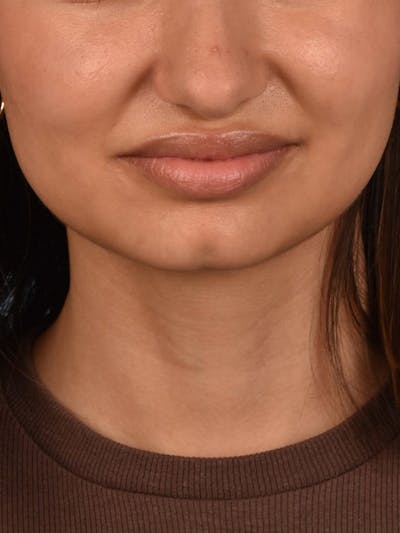 Dermal Fillers Before & After Gallery - Patient 212317 - Image 1