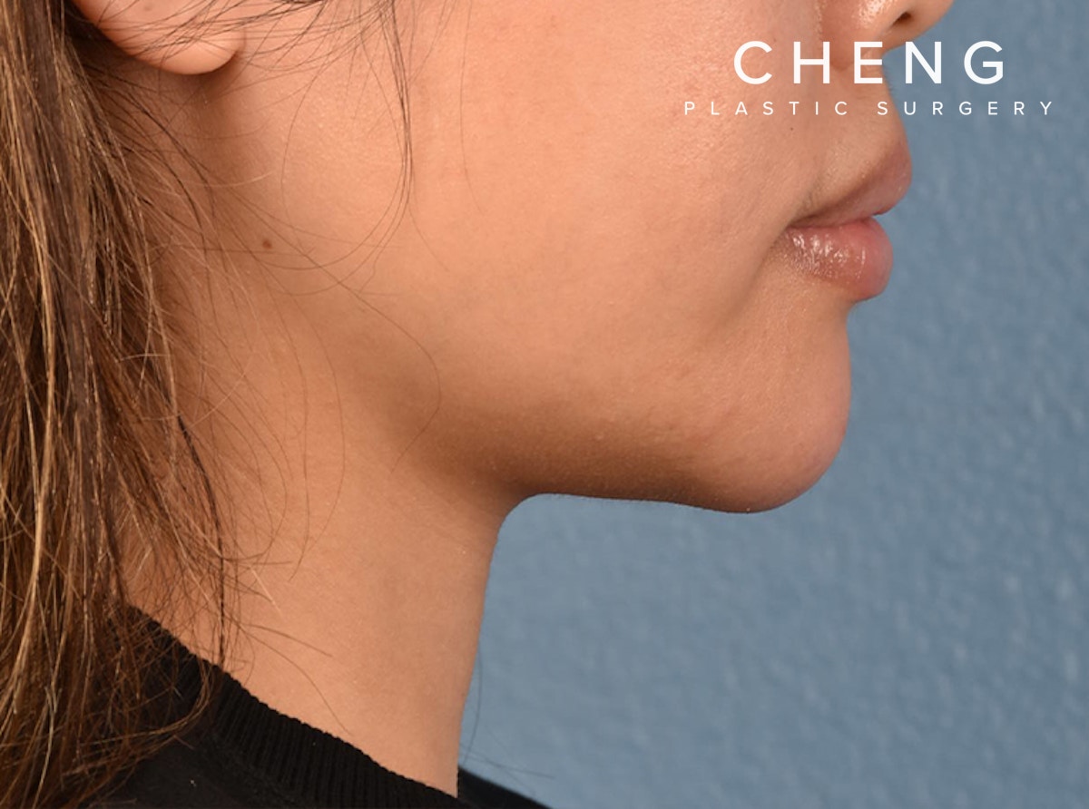 Dermal Fillers Before & After Gallery - Patient 145222 - Image 2