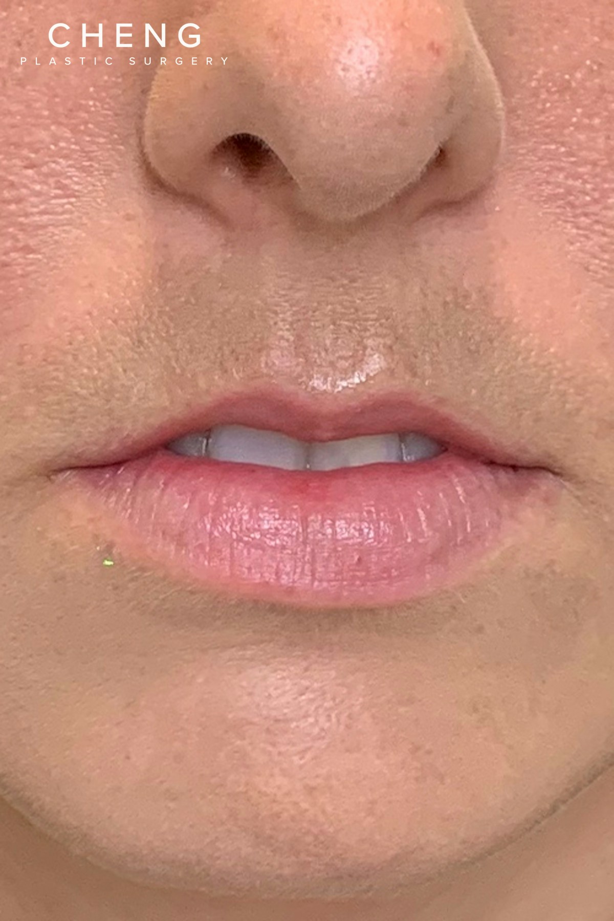 Dermal Fillers Before & After Gallery - Patient 300398 - Image 1
