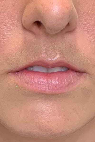 Dermal Fillers Before & After Gallery - Patient 300398 - Image 1