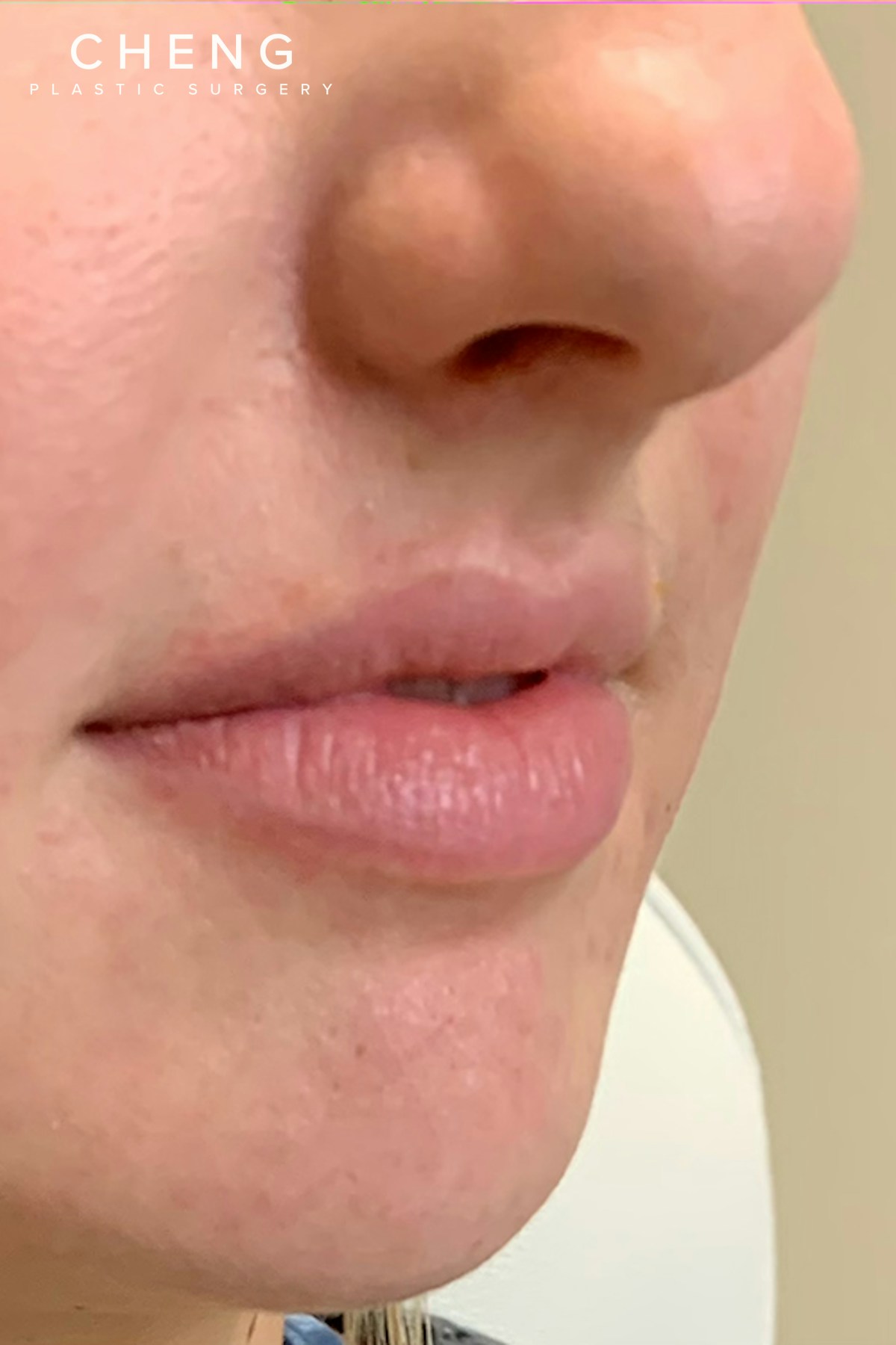Hidden Patients Before & After Gallery - Patient 150081 - Image 3