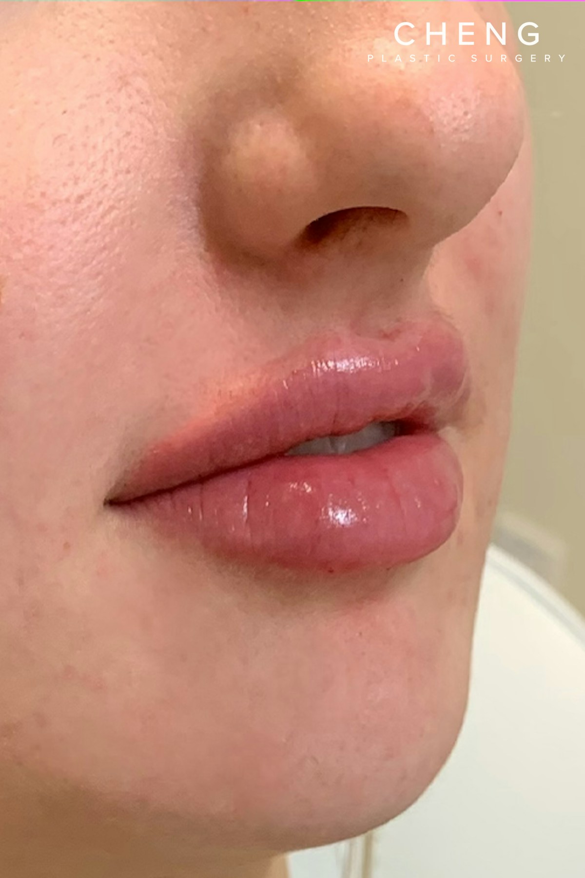 Hidden Patients Before & After Gallery - Patient 150081 - Image 4