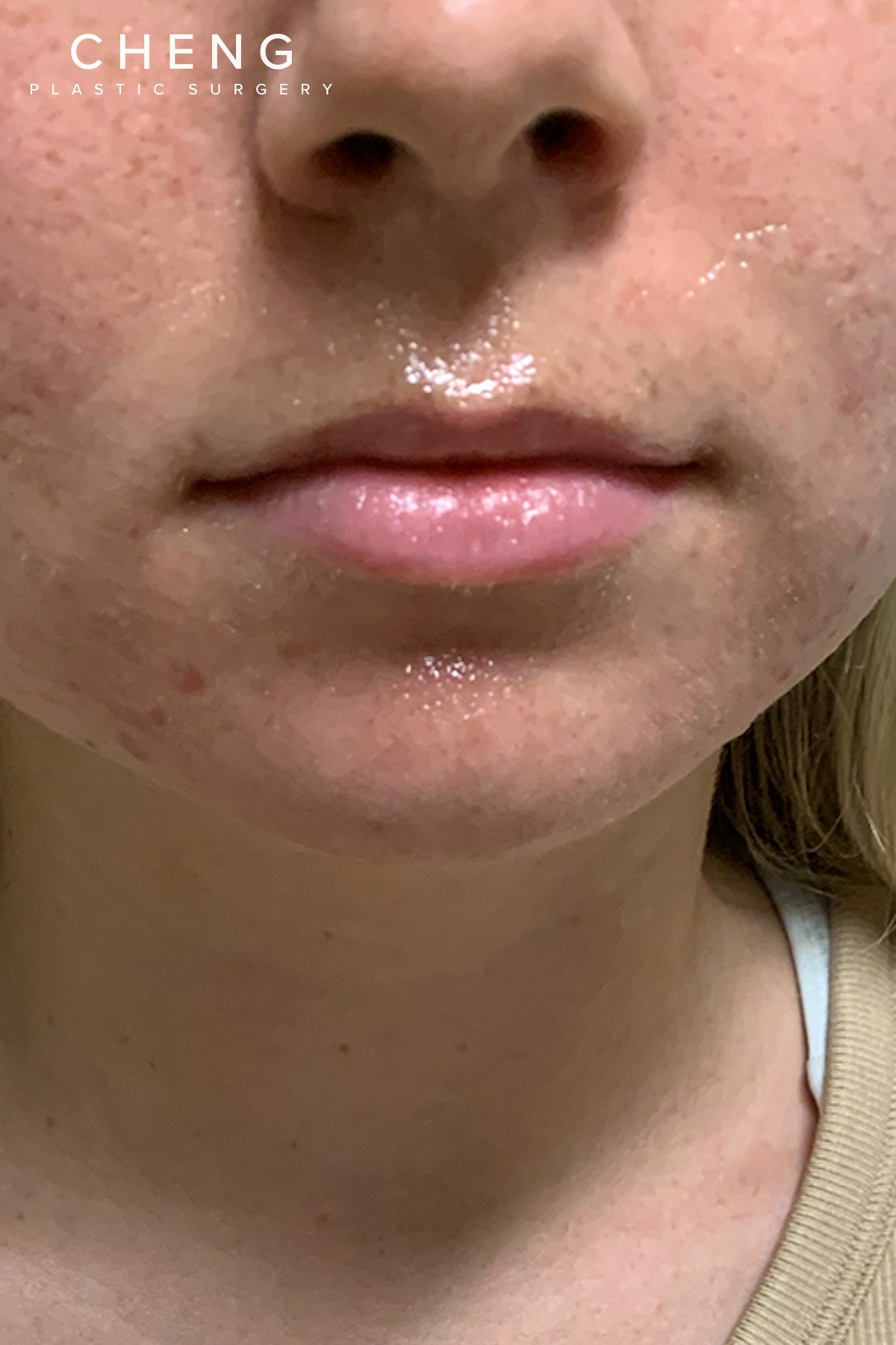 Dermal Fillers Before & After Gallery - Patient 222622 - Image 1