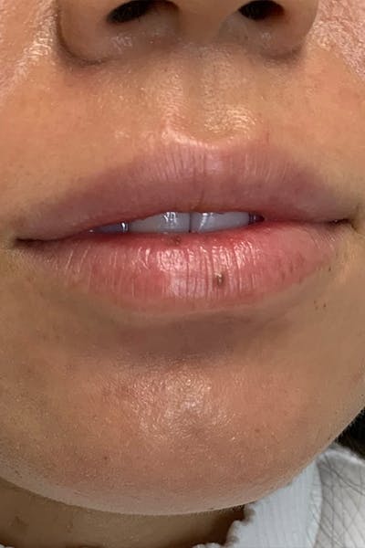 Hidden Patients Before & After Gallery - Patient 188403 - Image 1