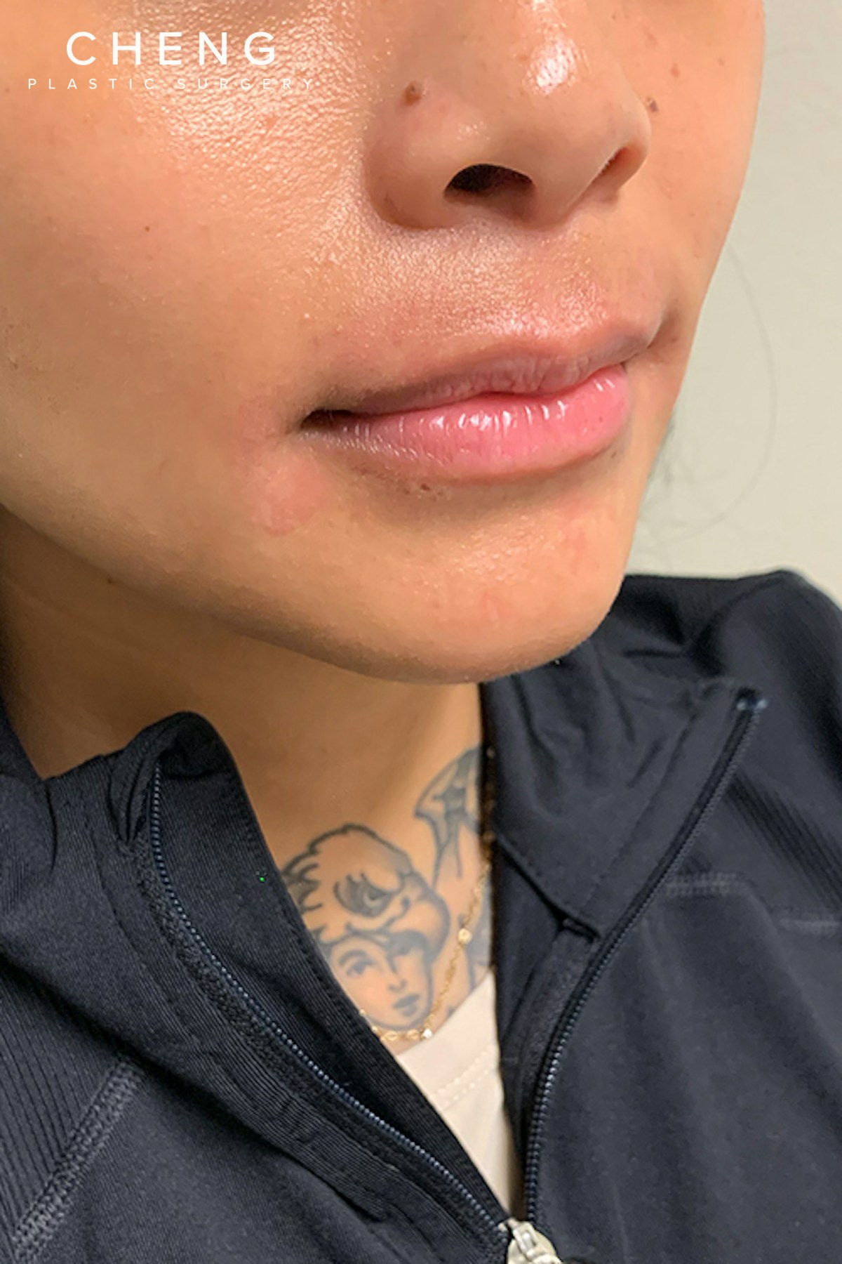 Dermal Fillers Before & After Gallery - Patient 399752 - Image 3