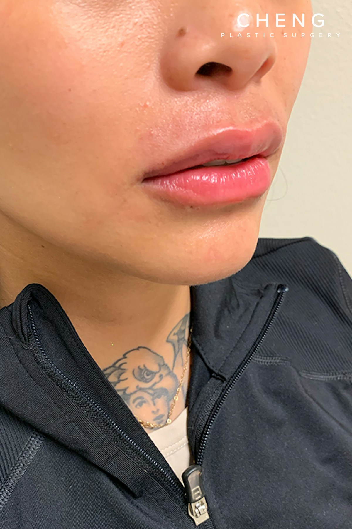 Dermal Fillers Before & After Gallery - Patient 399752 - Image 4