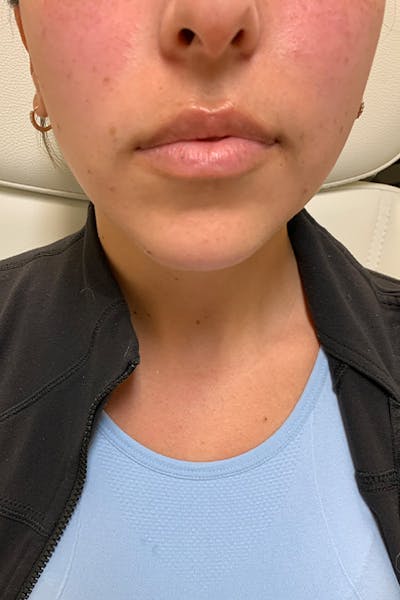 Hidden Patients Before & After Gallery - Patient 320250 - Image 1