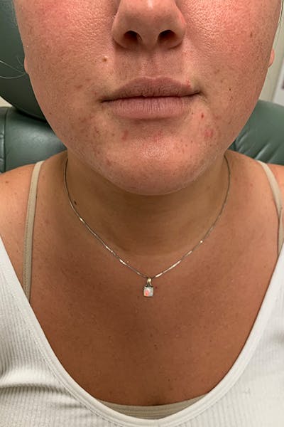 Hidden Patients Before & After Gallery - Patient 151109 - Image 1