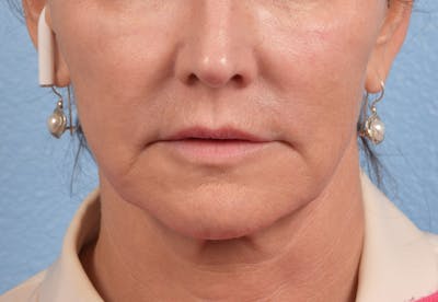 Hidden Patients Before & After Gallery - Patient 262095 - Image 1