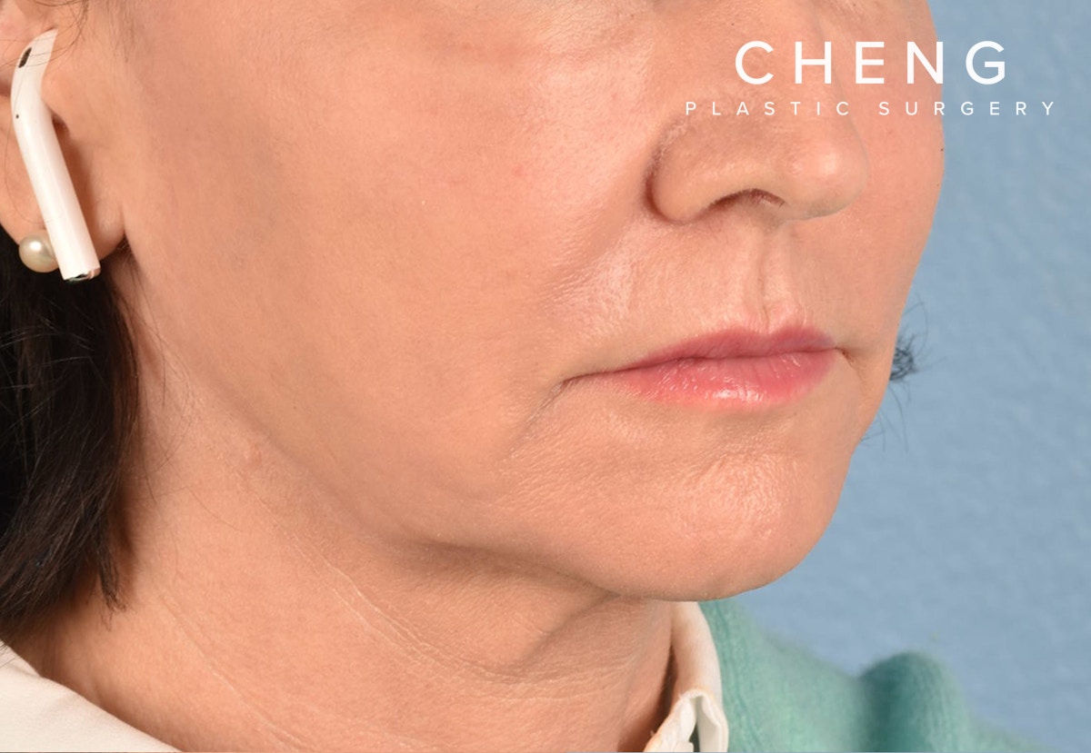 Hidden Patients Before & After Gallery - Patient 262095 - Image 10