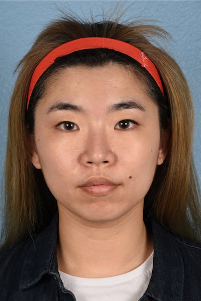 Thermage FLX  Before & After Gallery - Patient 614479 - Image 1