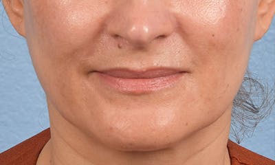 Hidden Patients Before & After Gallery - Patient 358781 - Image 2