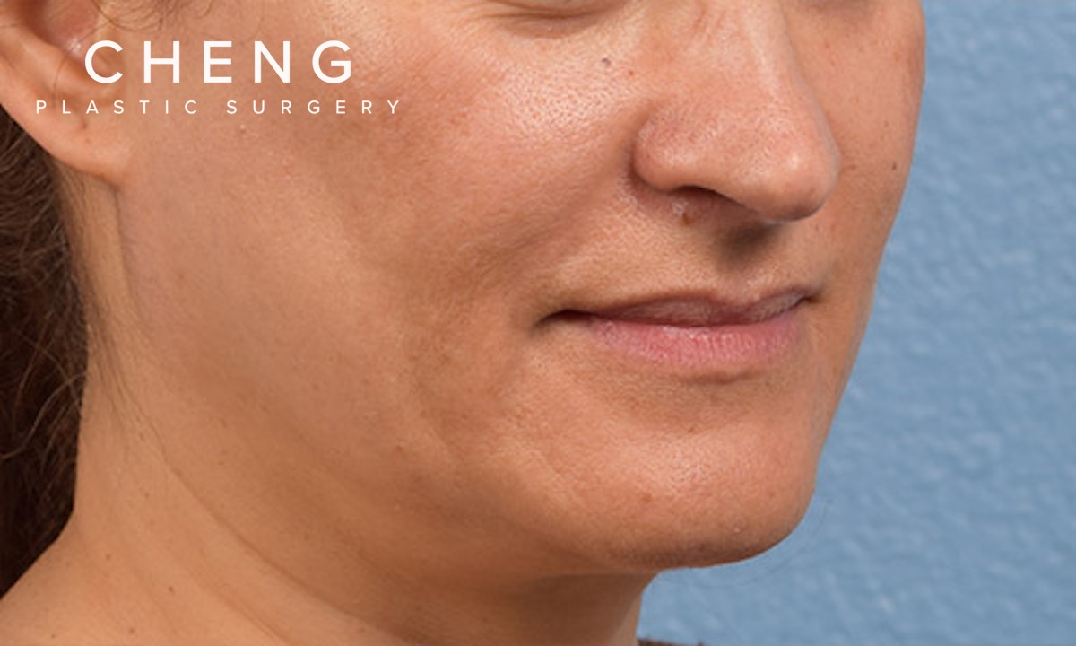Hidden Patients Before & After Gallery - Patient 358781 - Image 3
