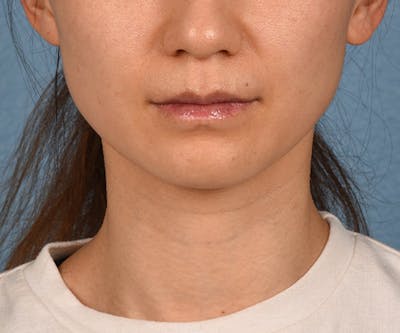 Hidden Patients Before & After Gallery - Patient 343443 - Image 2
