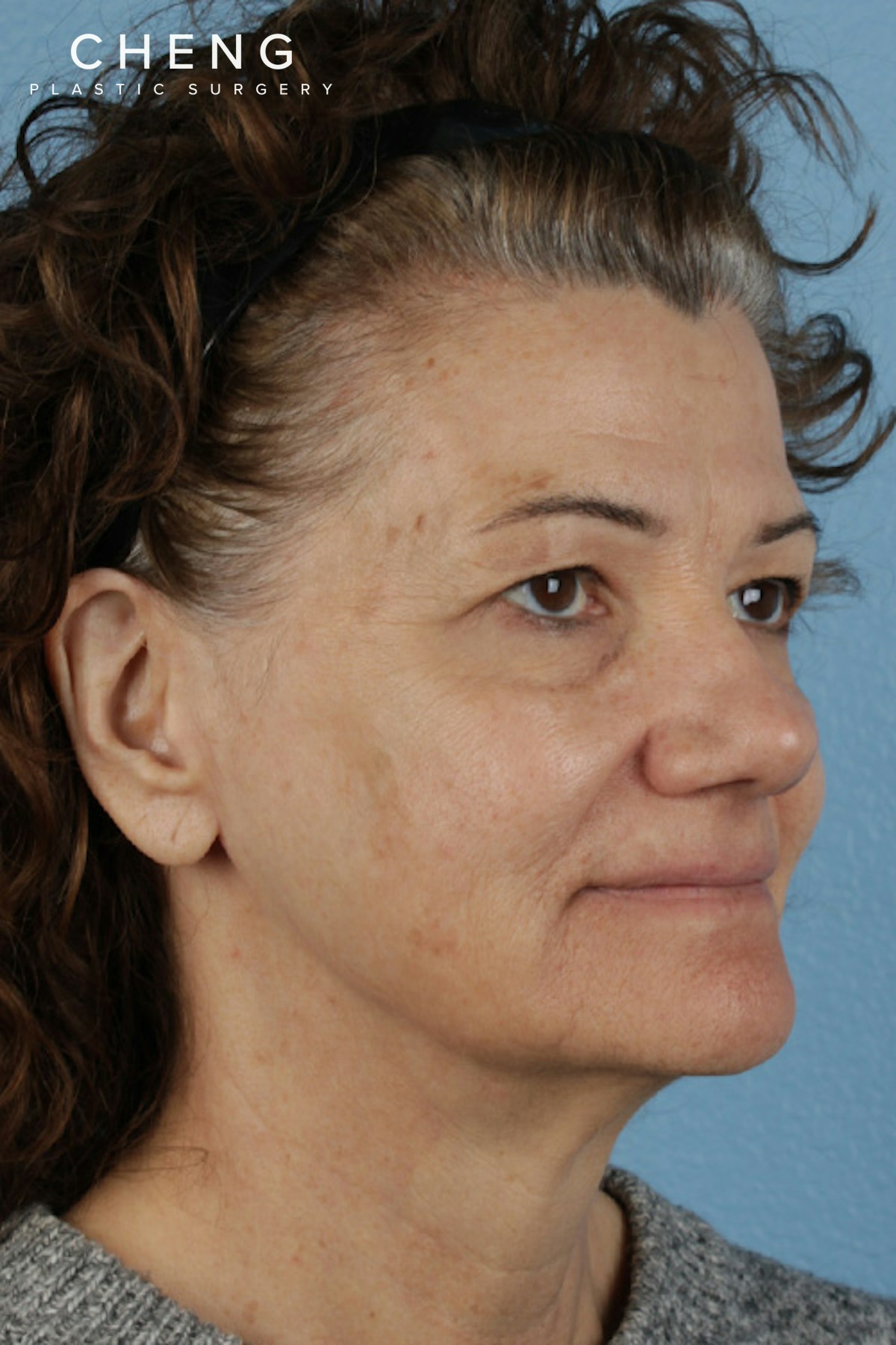 Pigment Laser Before & After Gallery - Patient 374844 - Image 3