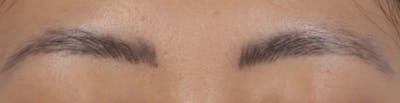 Brow Tattoo Removal Before & After Gallery - Patient 742306 - Image 1
