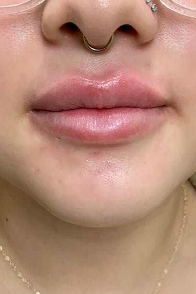 Hidden Patients Before & After Gallery - Patient 405070 - Image 1